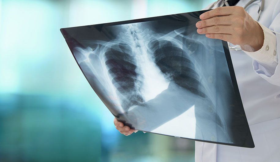 Pneumonia/ذات الریه