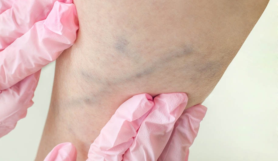 venous-thromboembolism-vte/ترومبوز وریدی